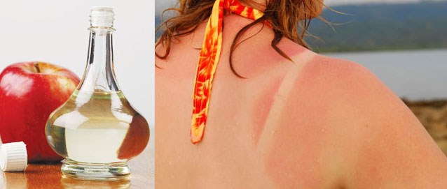 Dùng dấm trị da cháy nắng 